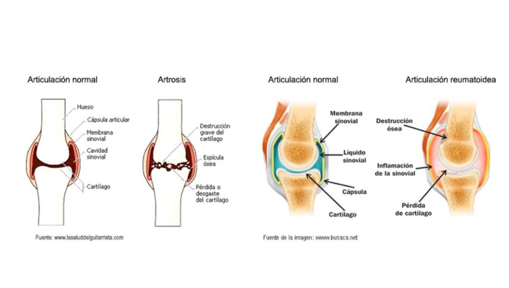 Diferencias entre artrosis y artritis